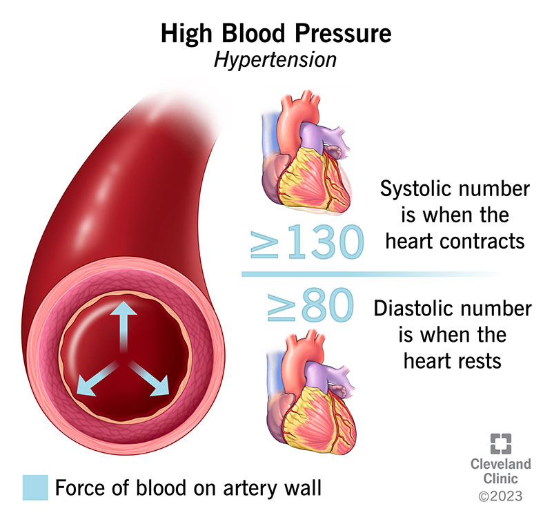 Why Many Ghanaians Don’t Take Hypertension Seriously—and How to Change That